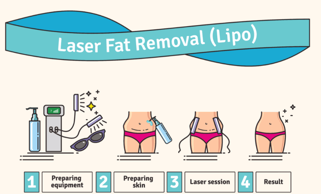 VelaShape review body contouring device