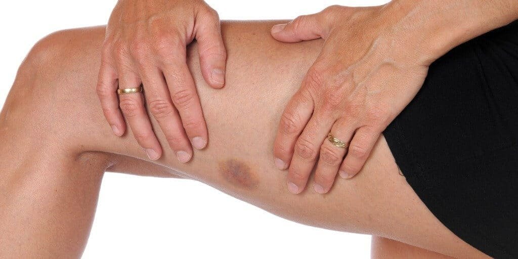 bodytite side effects bruising